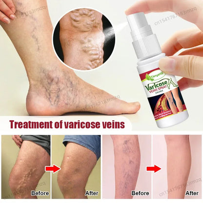 fachgo | Leg Care Treatment Cream Improve Varicose Veins To Relieve Leg Swelling and Pain Body Care Relieve leg discomfort