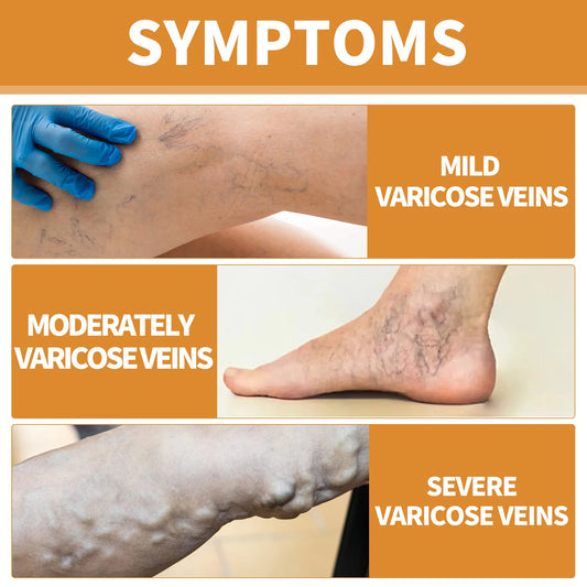 fachgo | Leg Treatment Cream Reducing Varicose Veins Remove Redness Repair Phlebitis Relieves Bulge Improving Circulation Body Care Cream