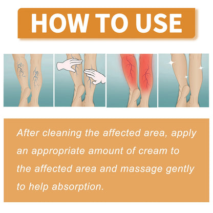 fachgo | Leg Treatment Cream Reducing Varicose Veins Remove Redness Repair Phlebitis Relieves Bulge Improving Circulation Body Care Cream