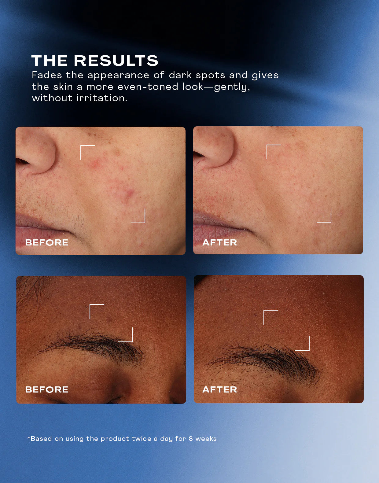 Results showing before and after effects of Total Clarity Dark Spot Serum on dark spots and uneven skin tone.